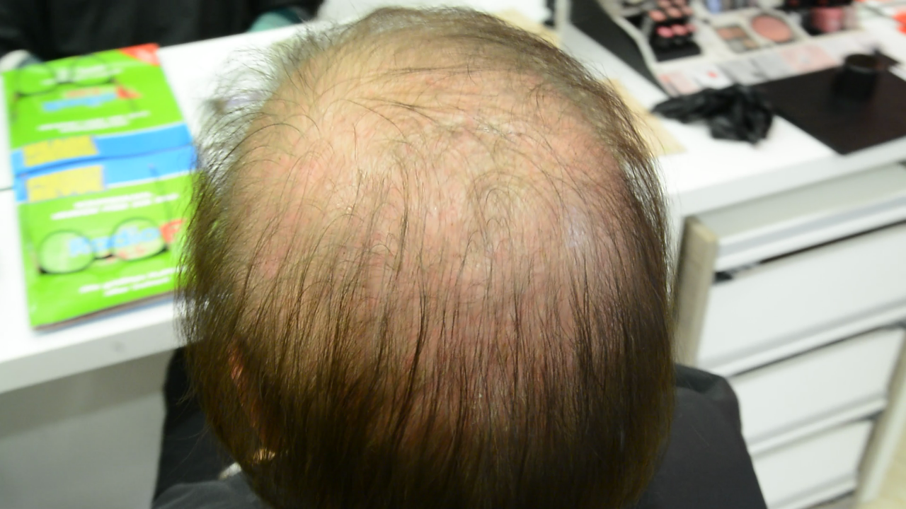 Frau mit ganz wenig Haaren vorher